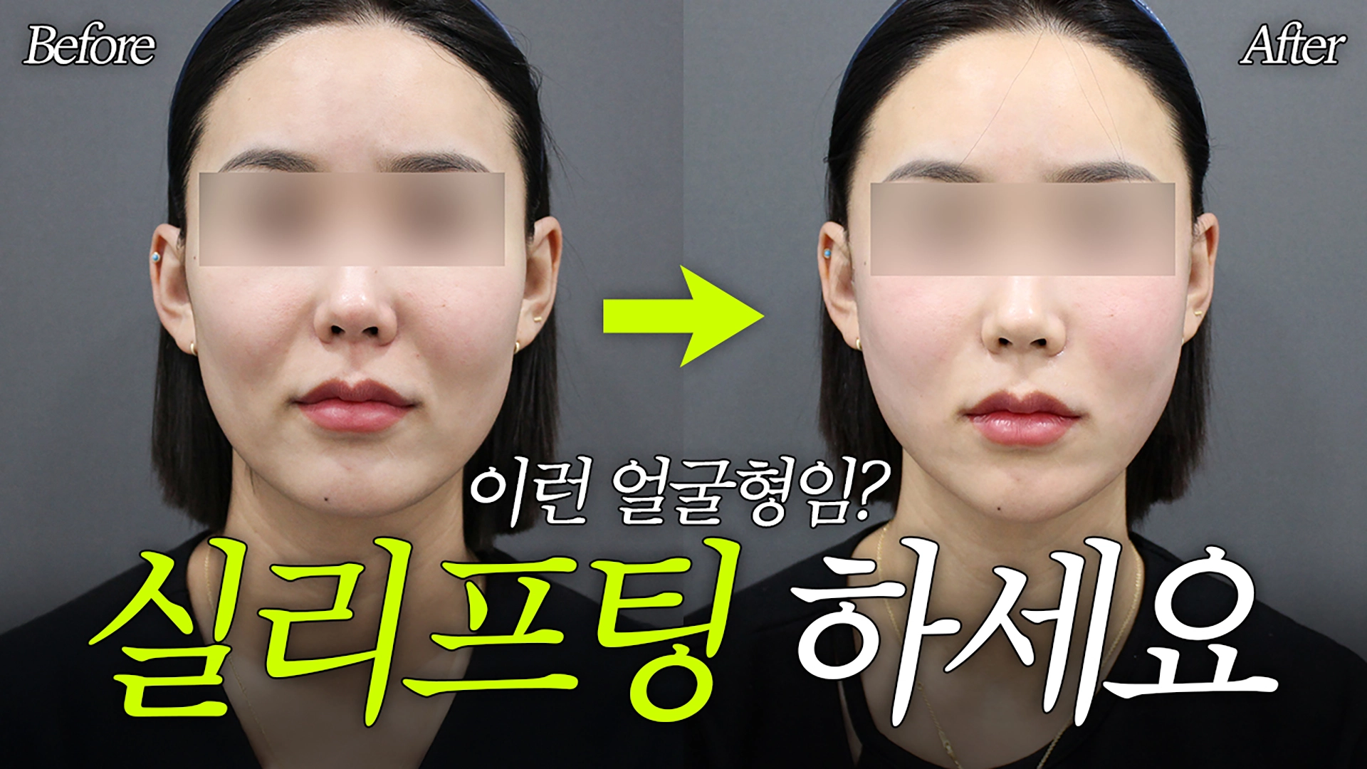 실터뷰 Ep 1 | 실리프팅이 잘 맞는 얼굴, 땅콩형 초입 썸네일