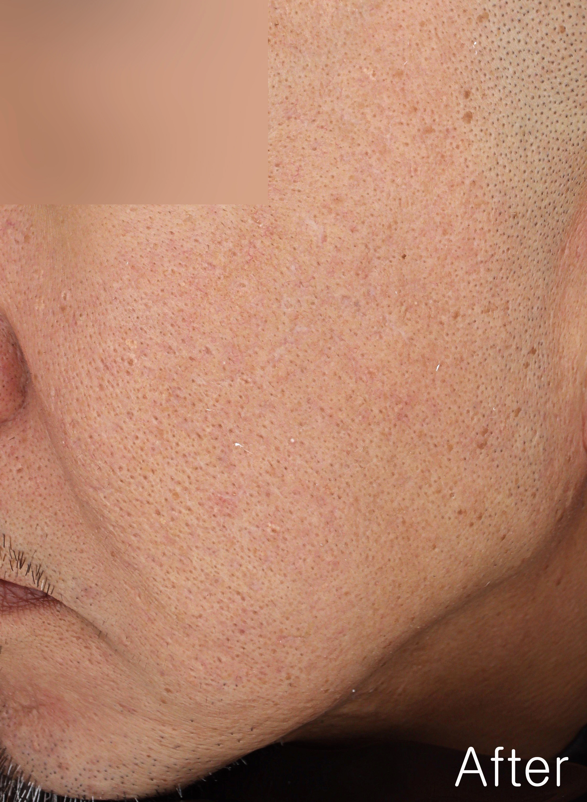 After image for pore and texture example