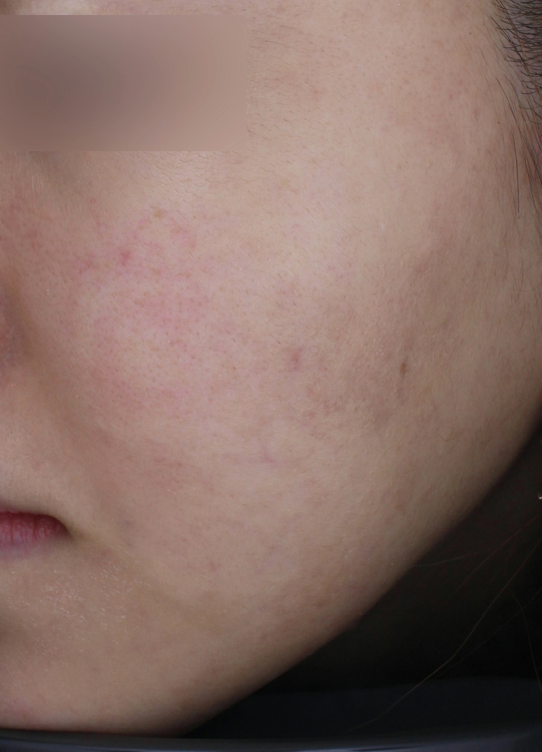 After image for pigmentation care example