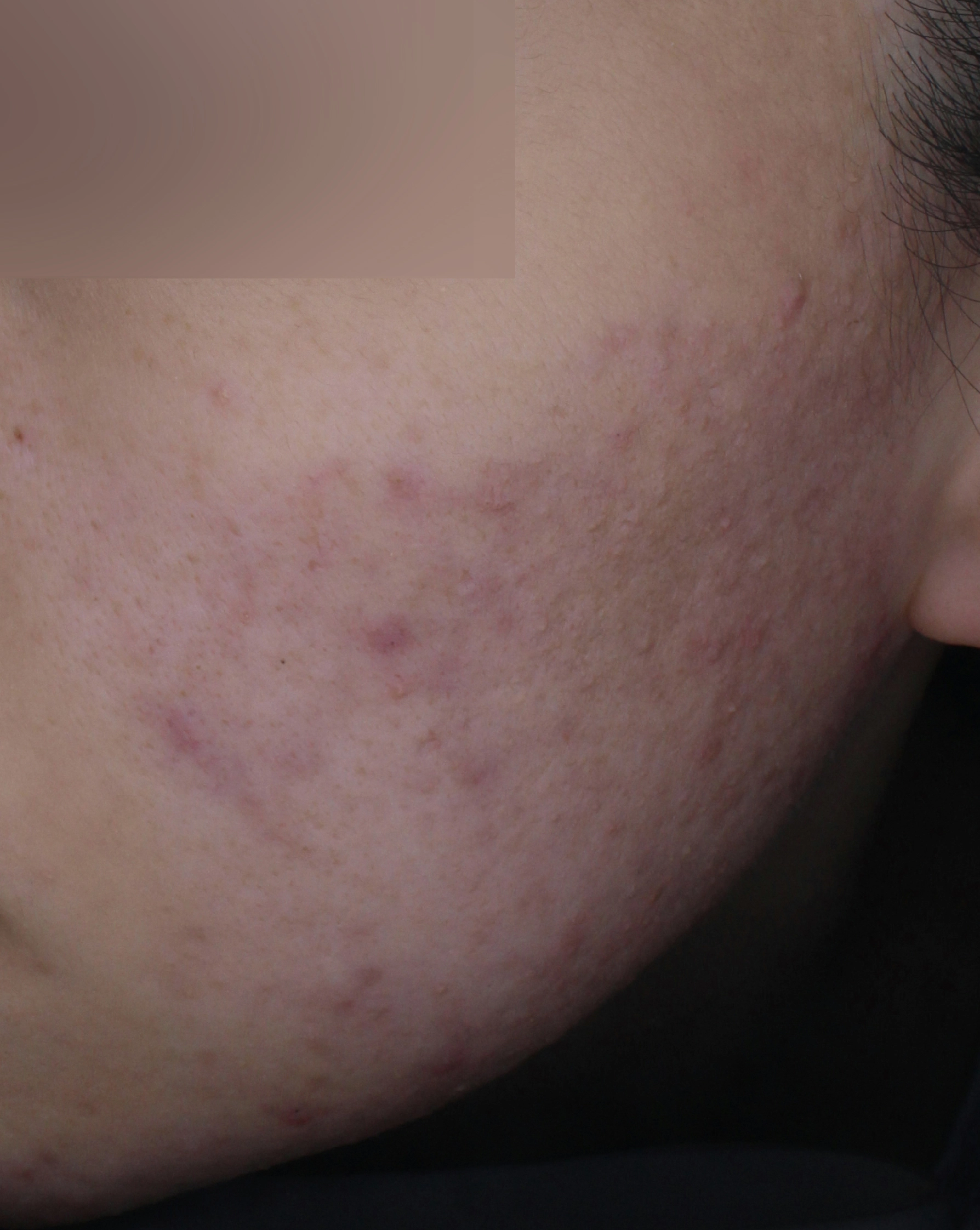 Before image for acne care example