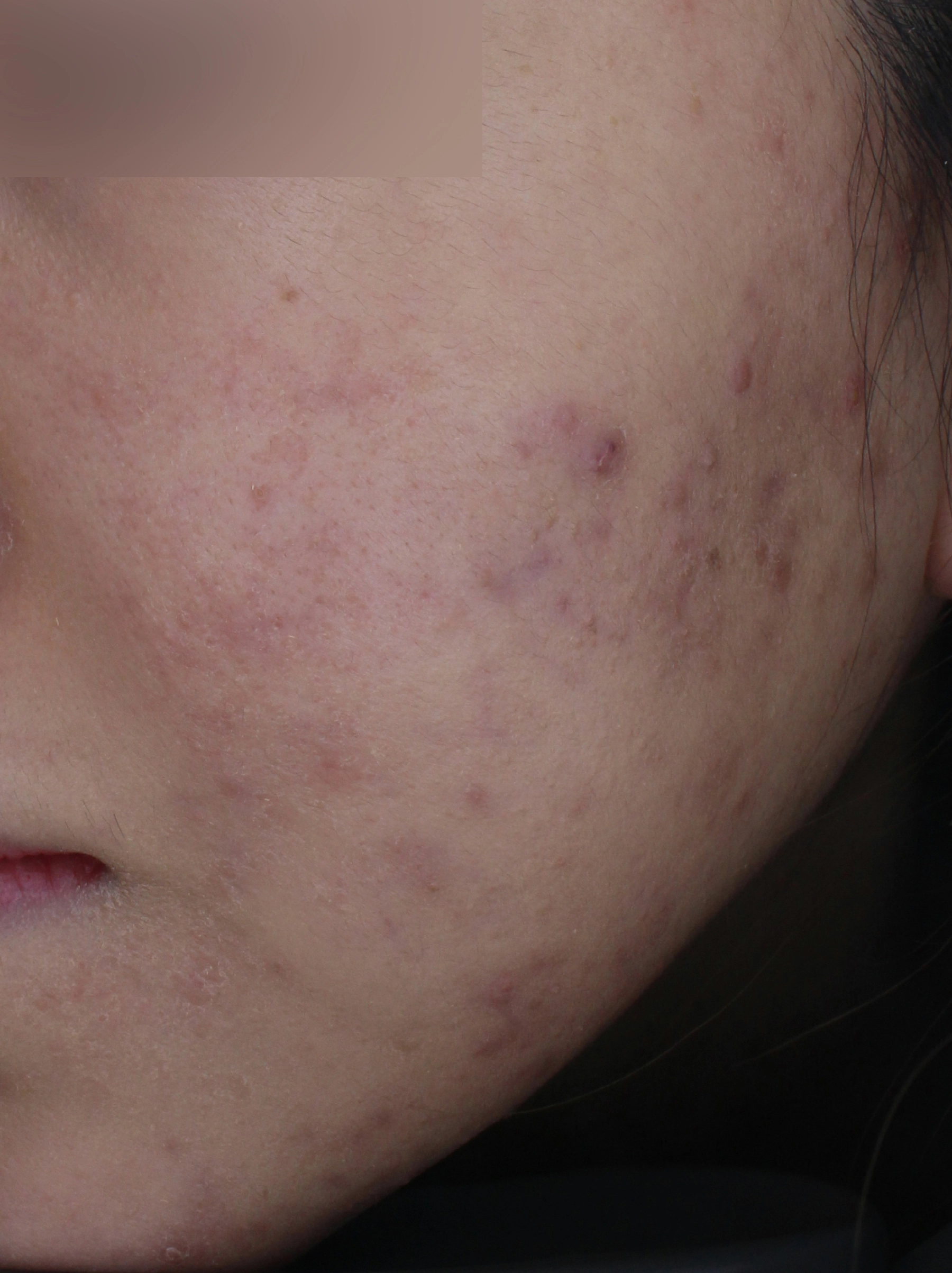Before image for pigmentation care example