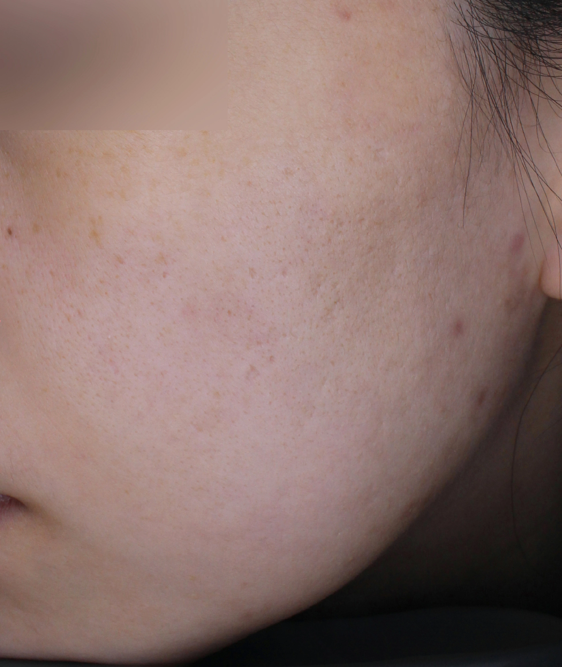 After image for acne care example