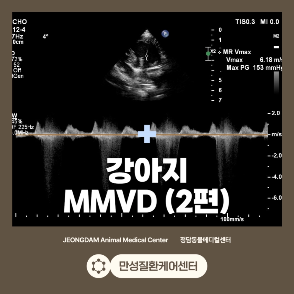 MMVD 치료 사례