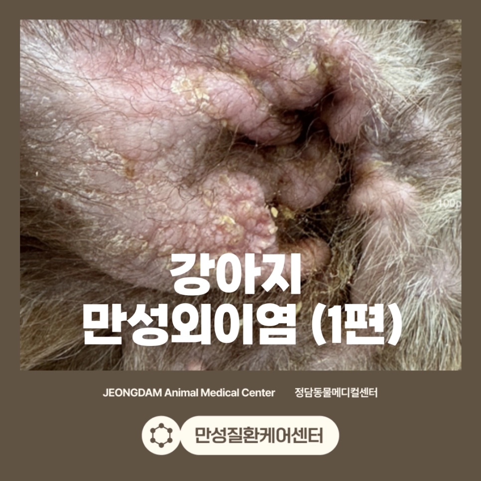 만성외이염 치료 사례