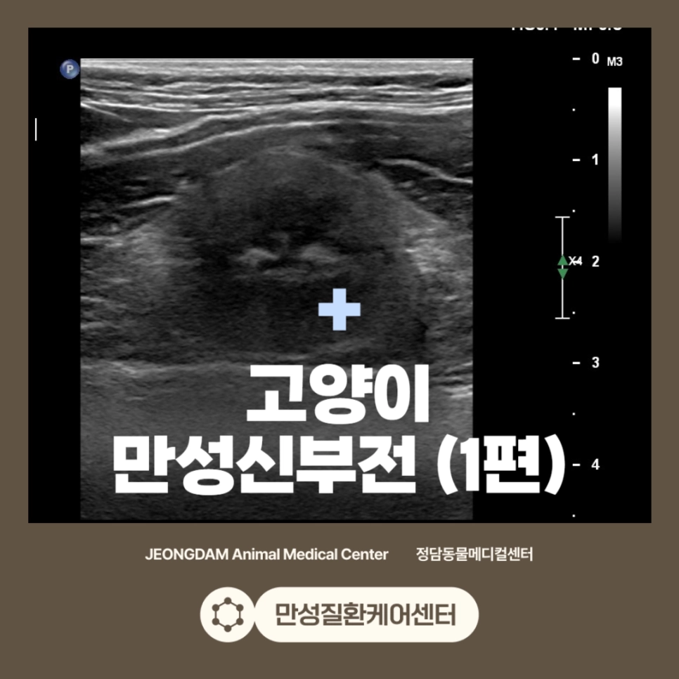 만성 신부전 치료 사례