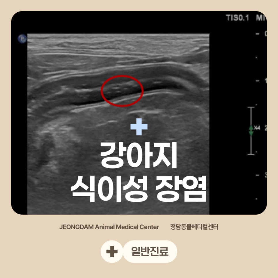 식이성 장염 치료 사례