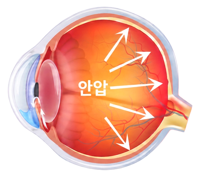 녹내장
